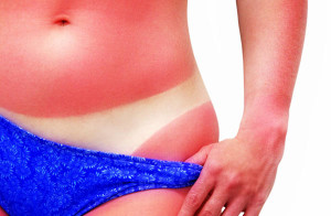 jak-zlagodzic-oparzenia-sloneczne_17761_w600